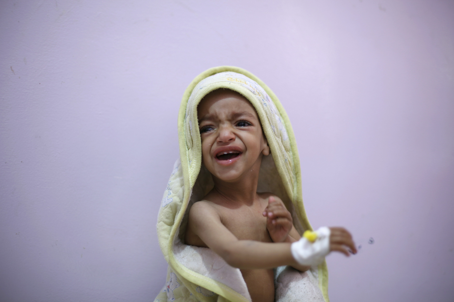 El coste de la guerra en Yemen: malnutrición, muertes y refugiados