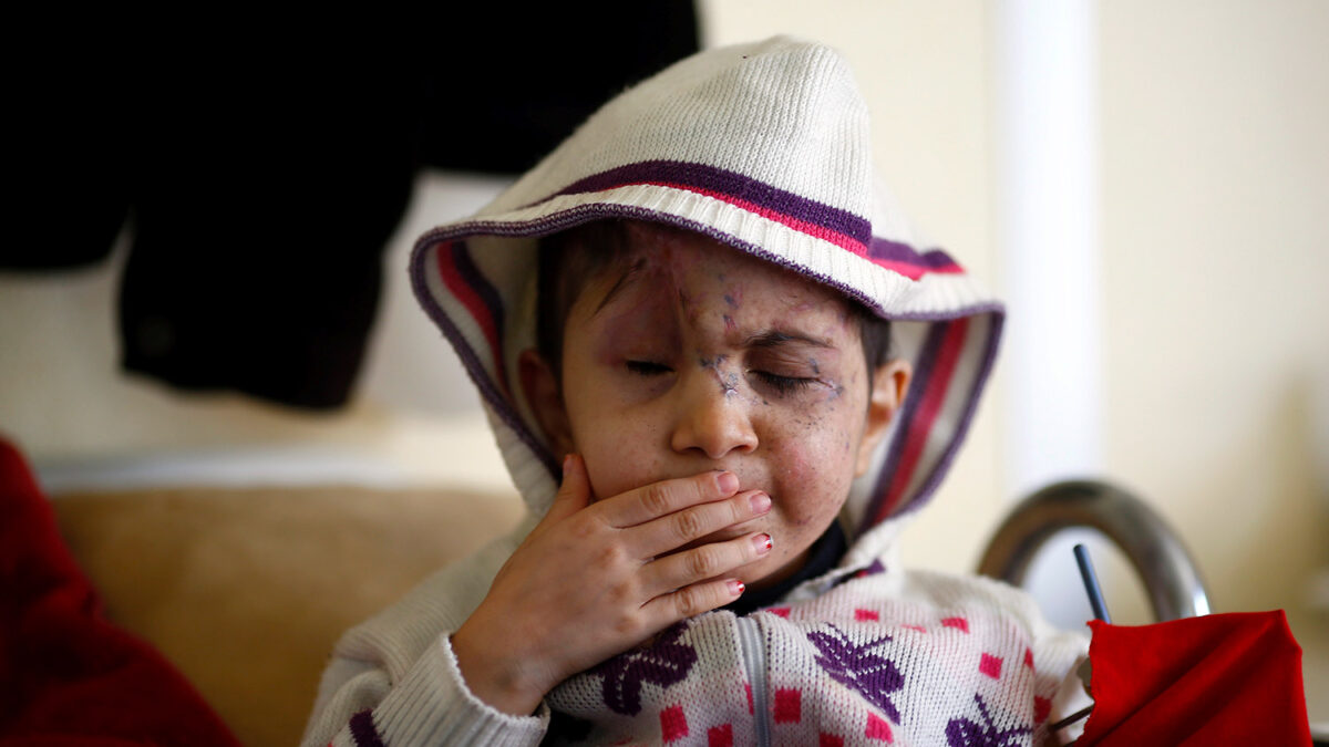 Sheima, el niño sirio que ha perdido sus ojos al ser disparado en la cabeza por un francotirador