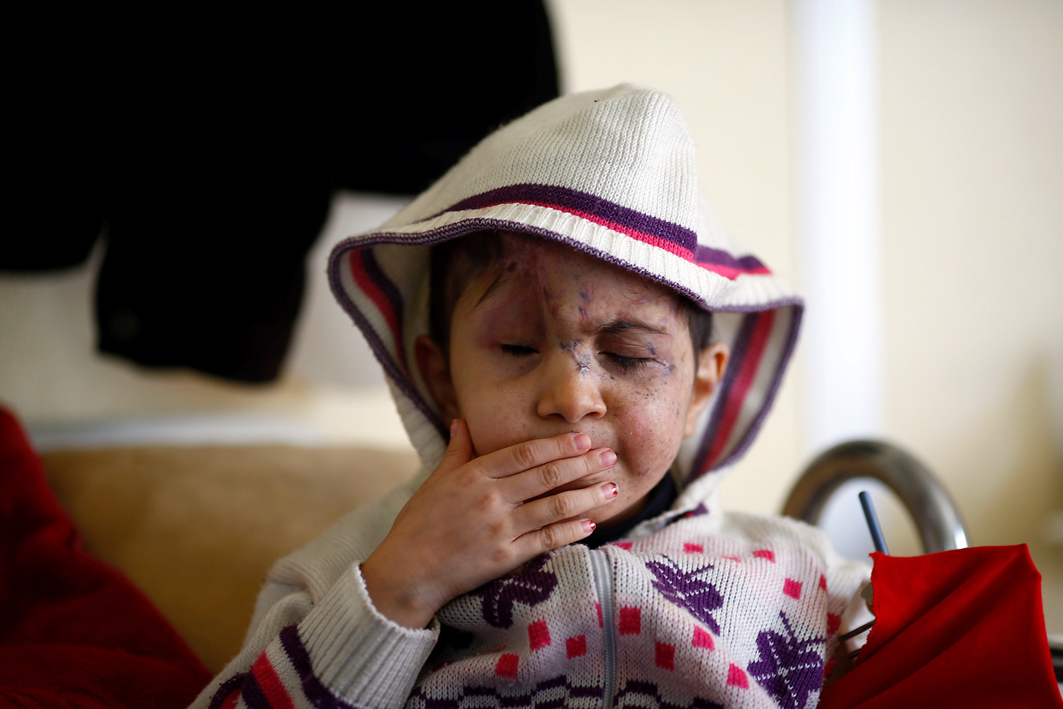 Sheima, el niño sirio que ha perdido sus ojos al ser disparado en la cabeza por un francotirador