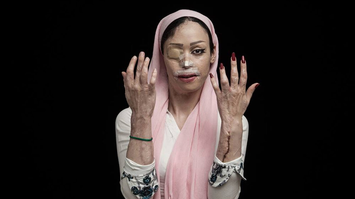 Los rostros de las víctimas del ácido en Irán, ganadores del Sony World Photography