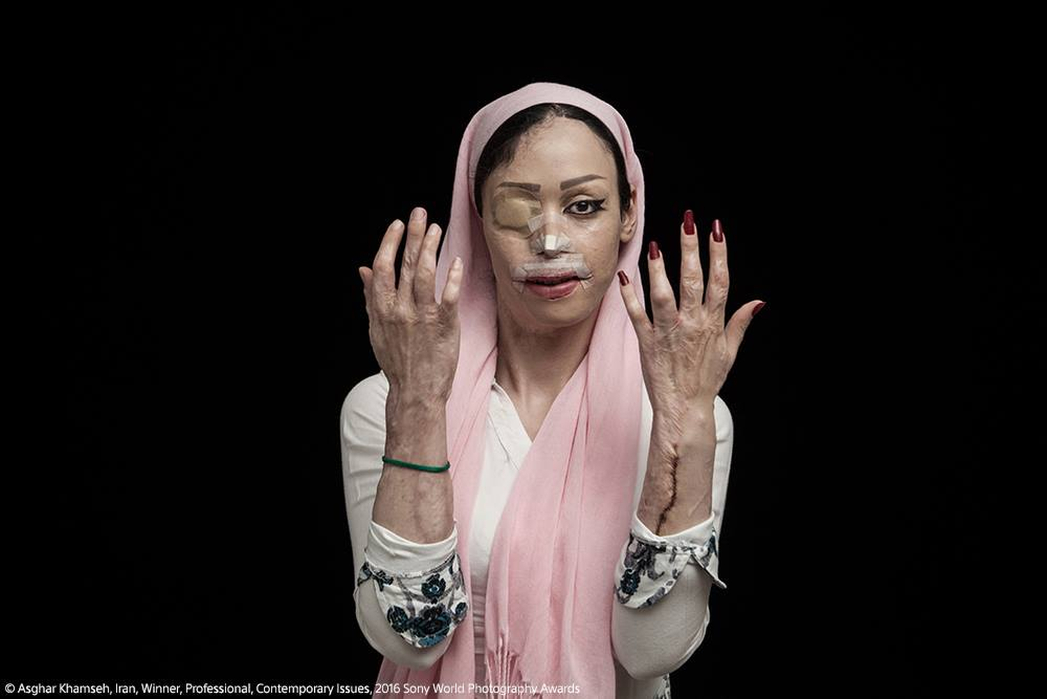 Los rostros de las víctimas del ácido en Irán, ganadores del Sony World Photography