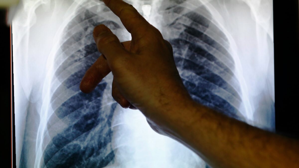 La tuberculosis mata a 1,8 millones de personas