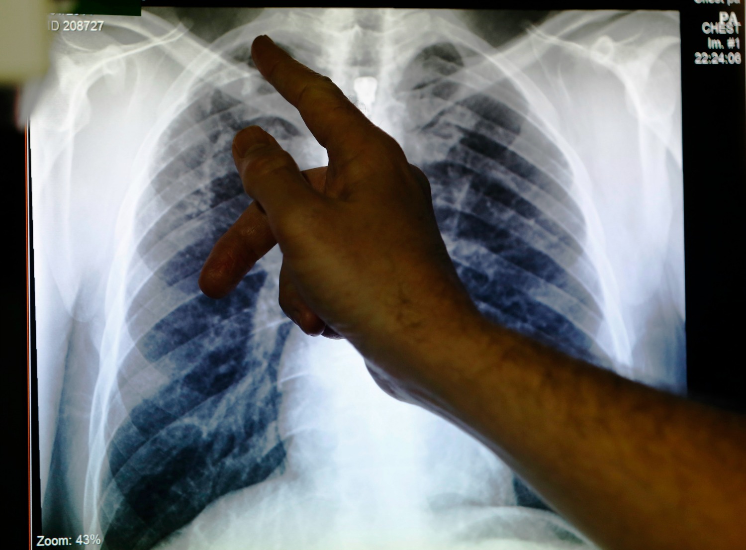La tuberculosis mata a 1,8 millones de personas