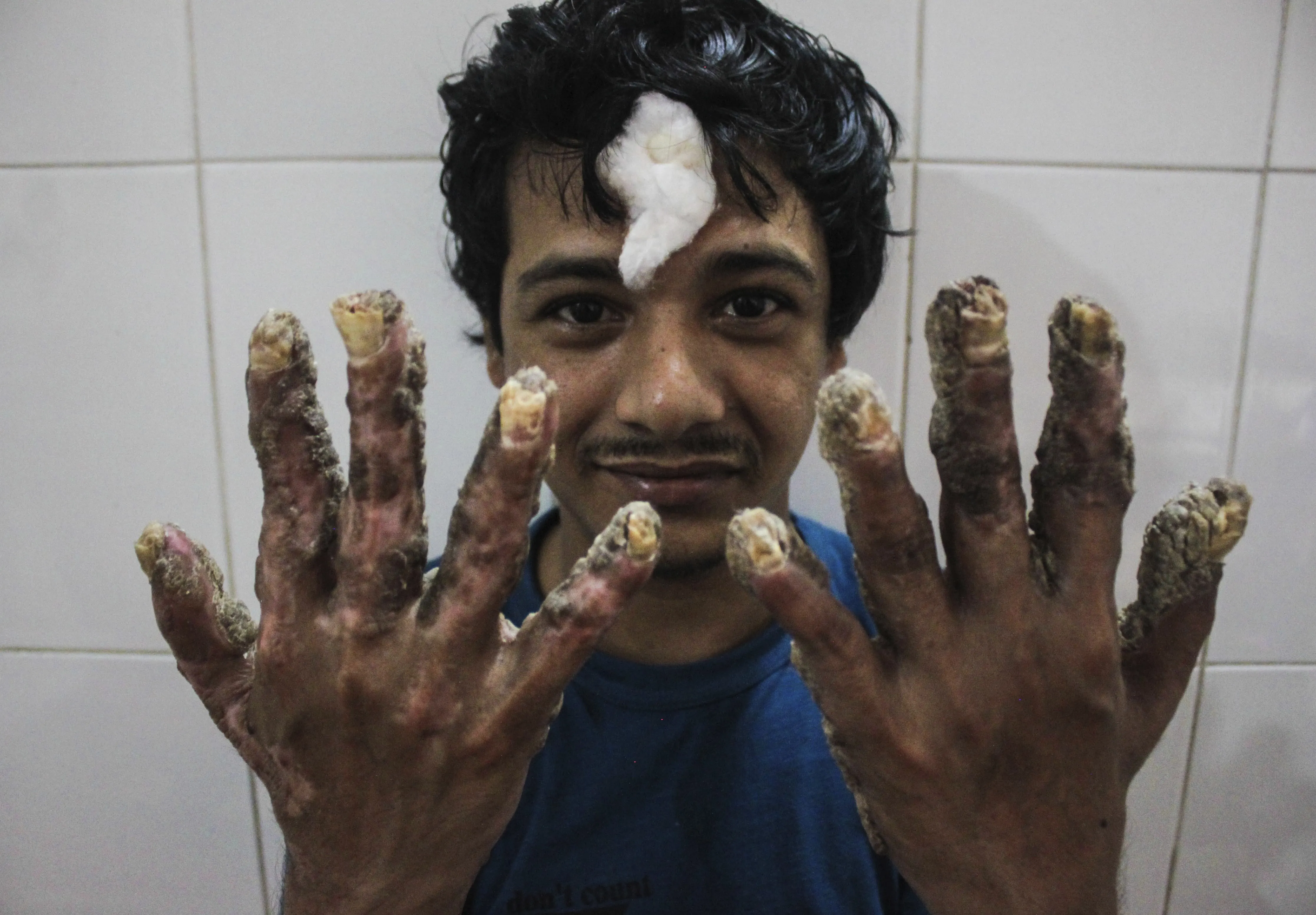 Abul Bajandar tras la operación en agosto de 2016. (Foto: Abir Abdullah| EFE)