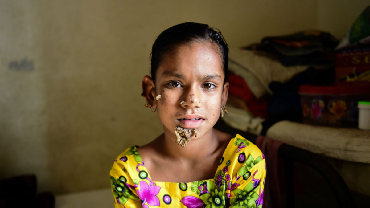 Una niña de Bangladés, la primera mujer con el síndrome del ‘hombre árbol’