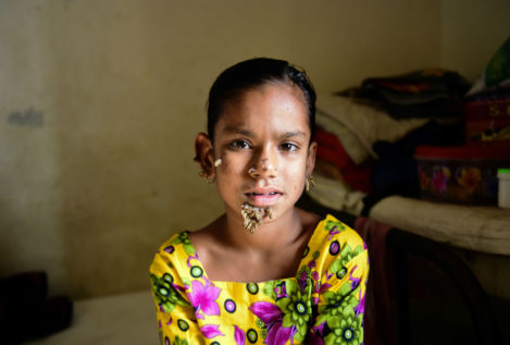 Una niña de Bangladés, la primera mujer con el síndrome del 'hombre árbol'