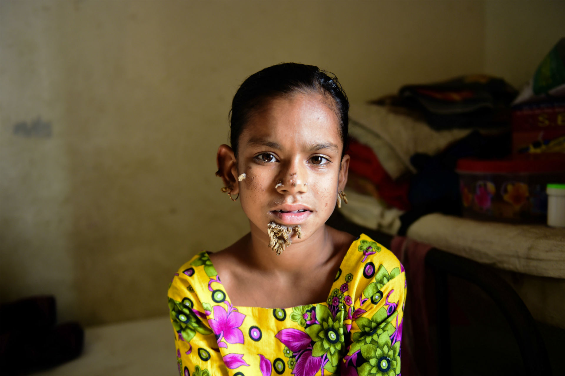 Una niña de Bangladés, la primera mujer con el síndrome del 'hombre árbol'