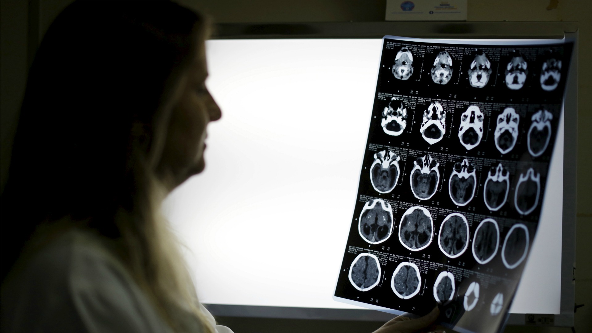 Descubren la zona del cerebro donde los pacientes con esquizofrenia «oyen voces»