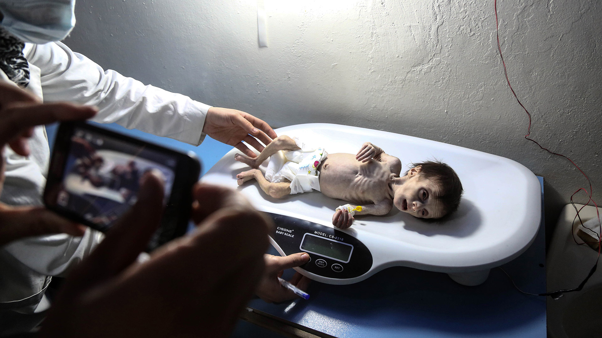 La muerte de una niña de 2 kilos de peso desata las alarmas por la malnutrición en Siria
