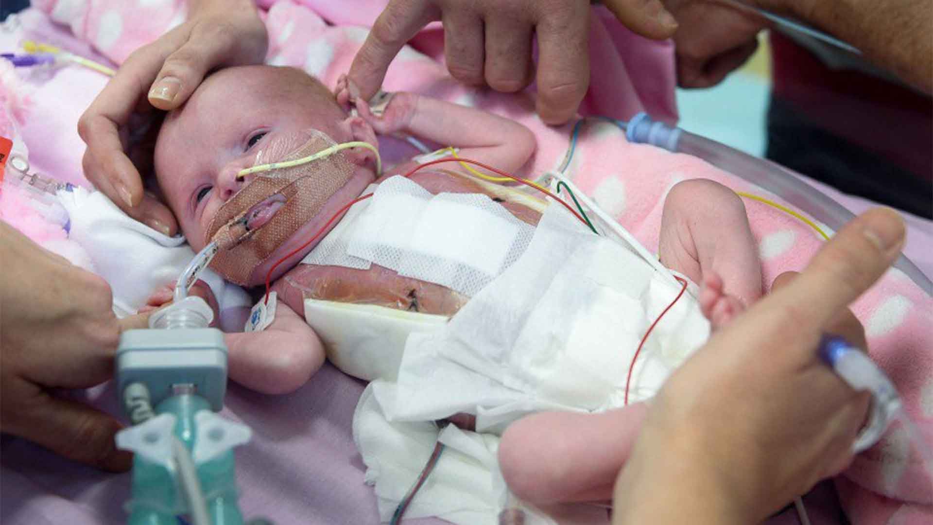 Una bebé británica que nació con el corazón fuera de la caja torácica sobrevive a tres cirugías