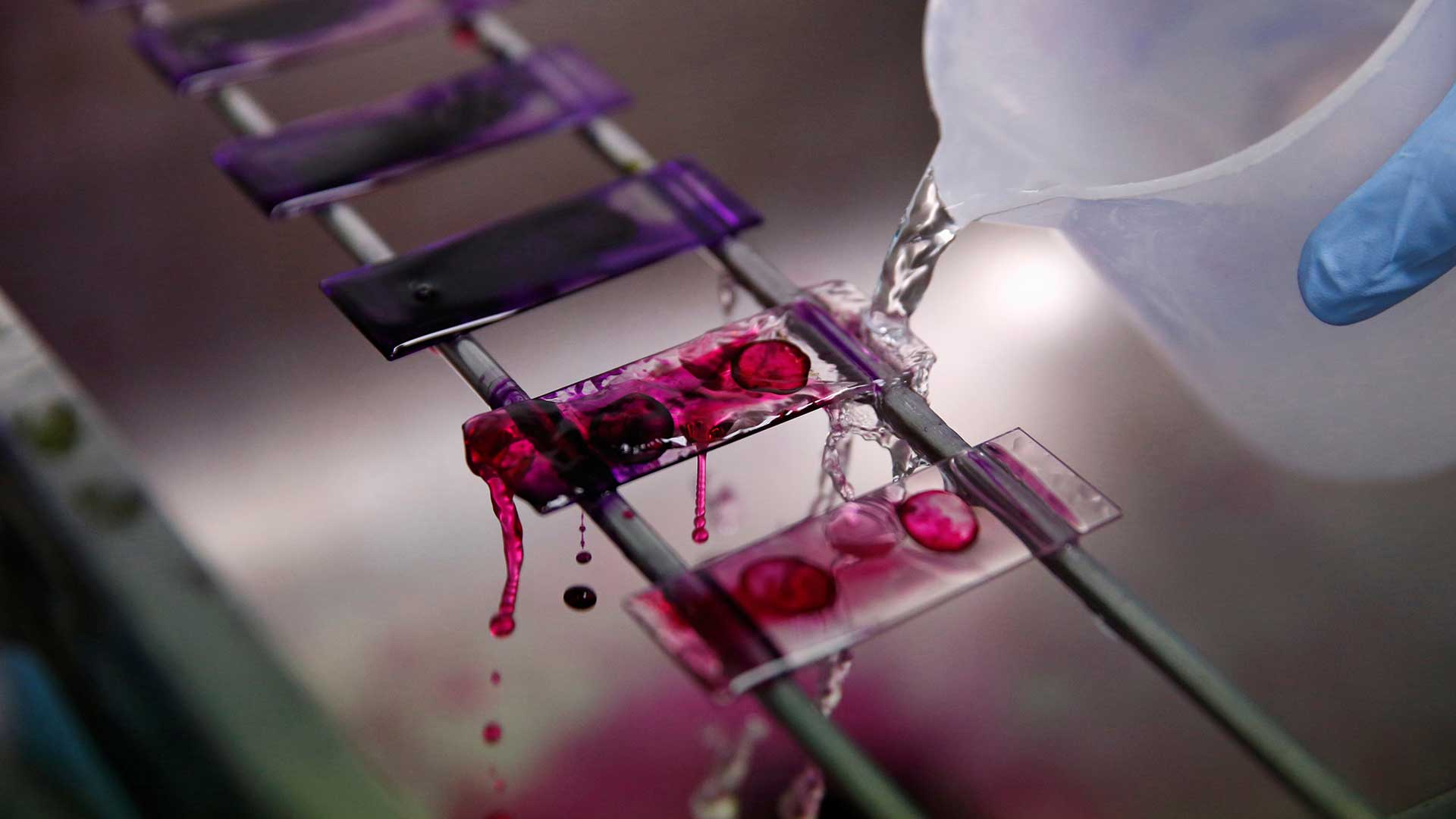 Desarrollan un análisis de sangre que detecta de forma precoz ocho tipos de cáncer