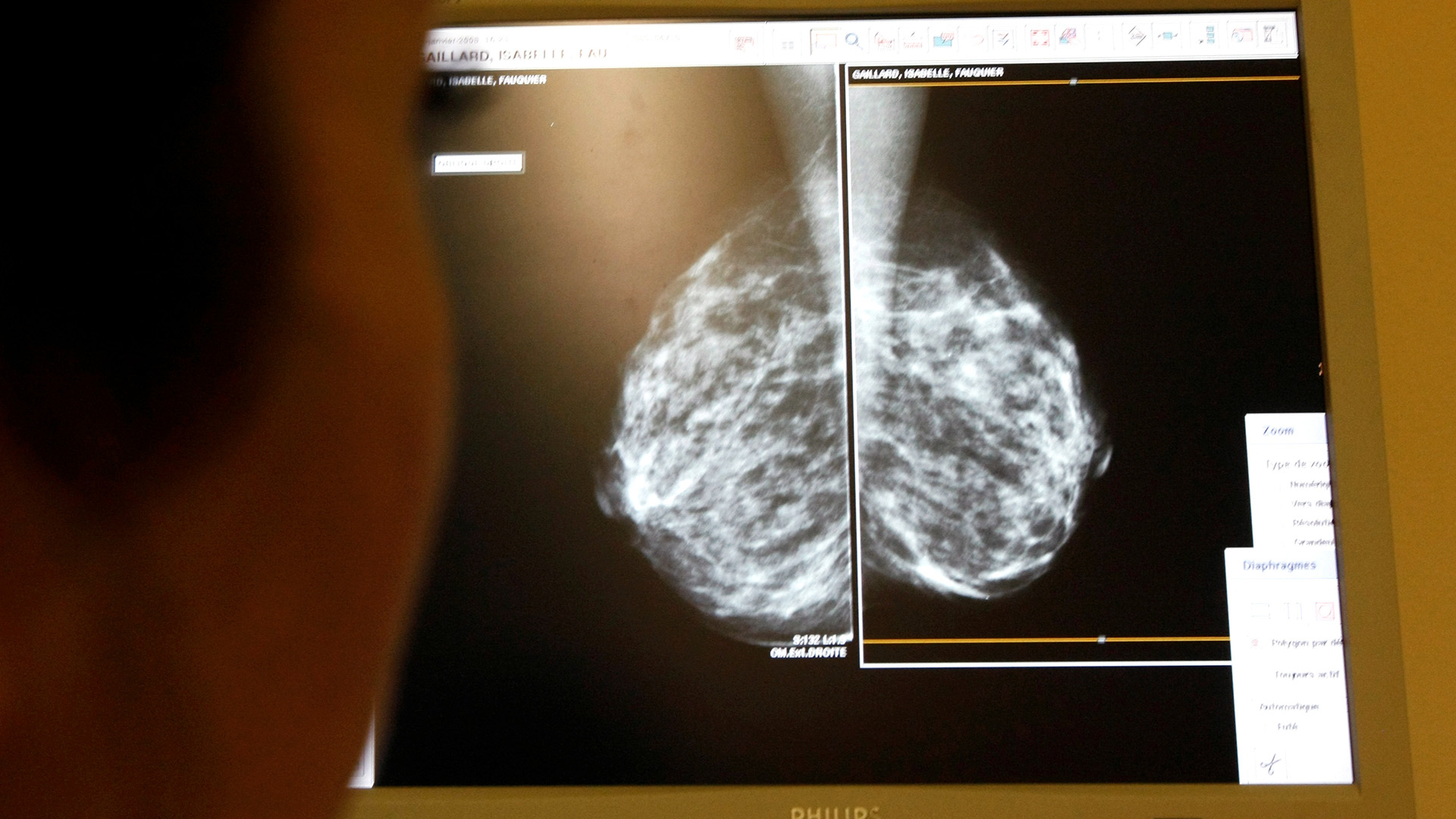 Un error informático dejó a 450.000 mujeres sin mamografías en Reino Unido