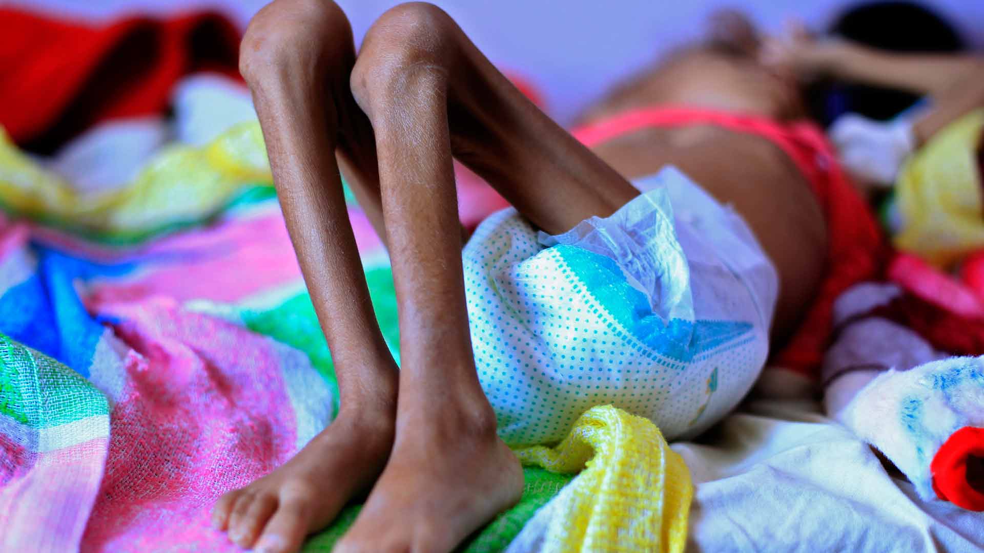 La ONU advierte de que Yemen sufre «una de las peores hambrunas de la historia»