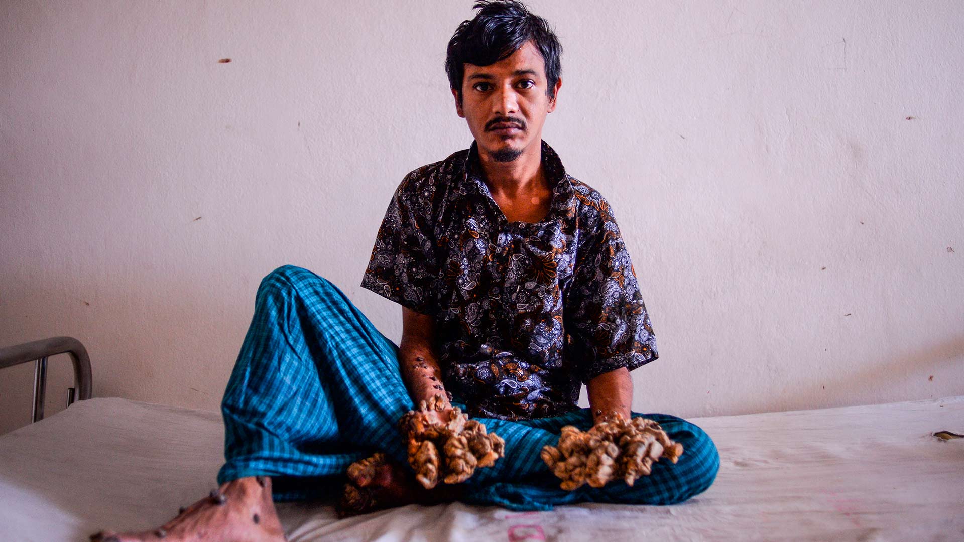 El ‘hombre-árbol’ bangladesí pide ser amputado por el «insoportable dolor»