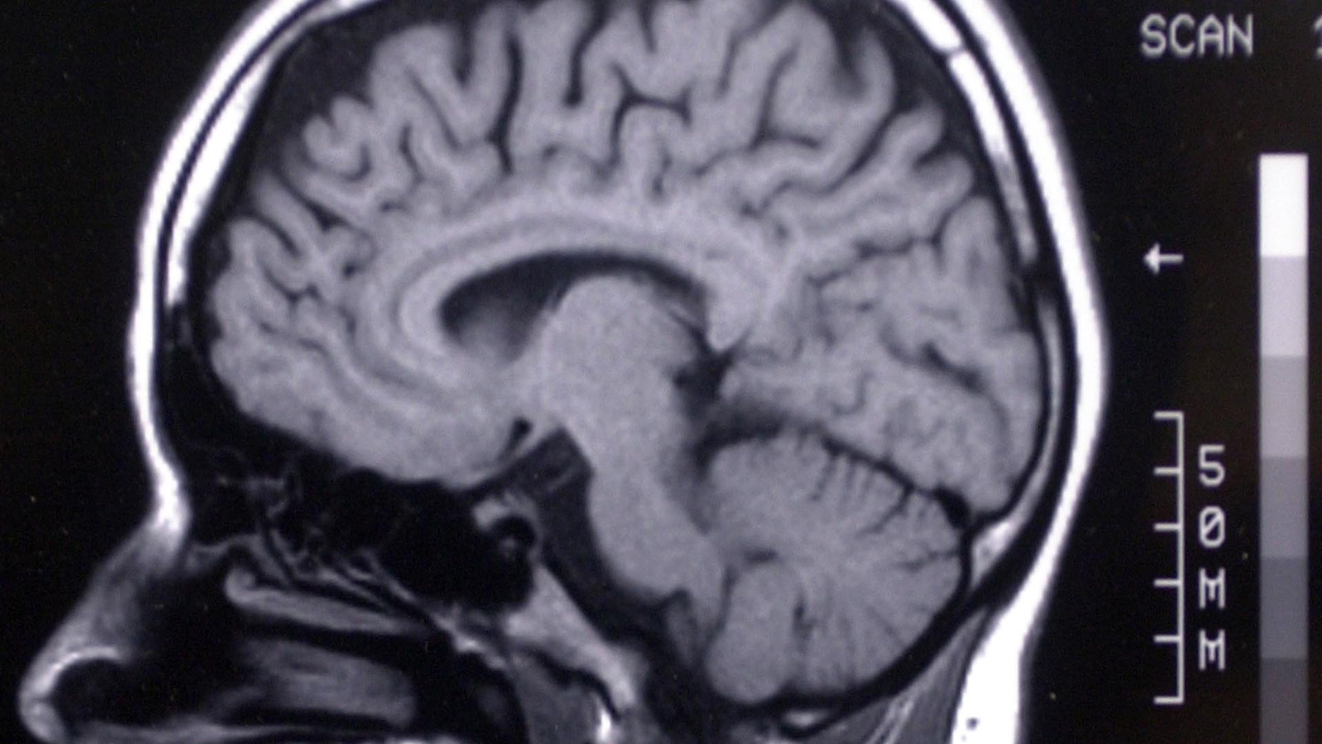 Científicos desarrollan una nueva terapia que elimina el cáncer cerebral