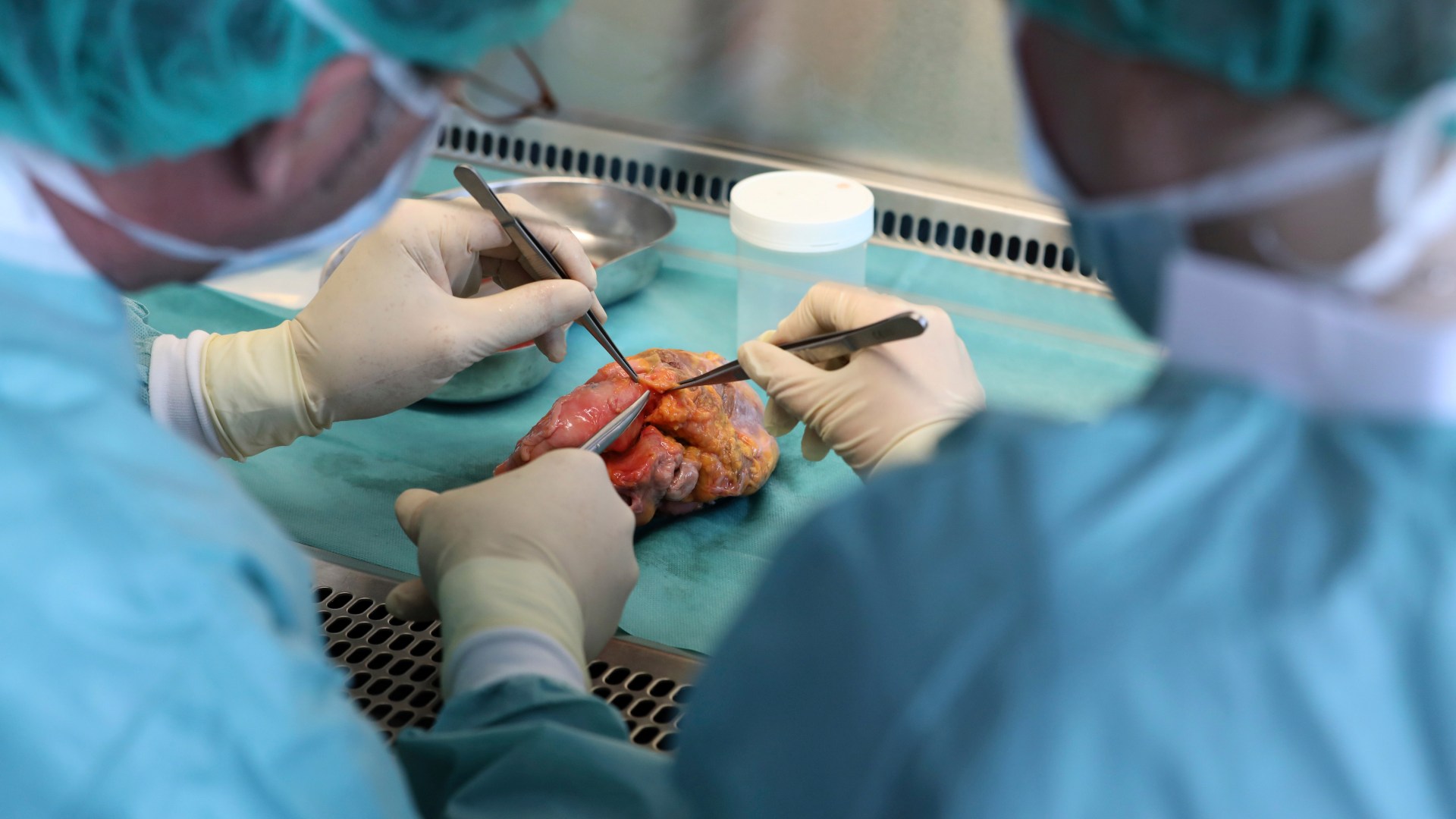 El 86% de las familias dona los órganos de sus familiares cuando fallecen