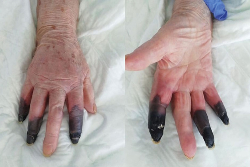 Amputados tres dedos a una anciana por una secuela del coronavirus