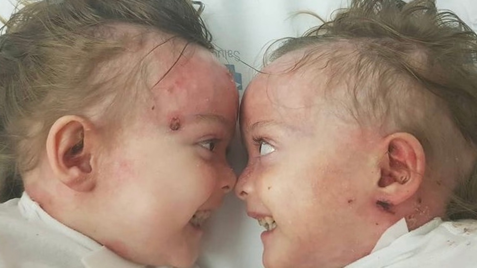 Un enfermero para Carla y Noa, las gemelas que padecen la enfermedad de Piel de Mariposa