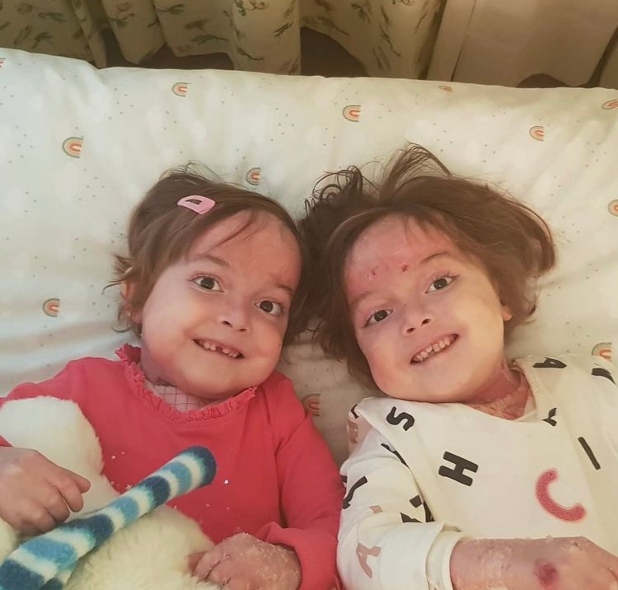 Un enfermero para Carla y Noa, las gemelas que padecen la enfermedad de Piel de Mariposa 1