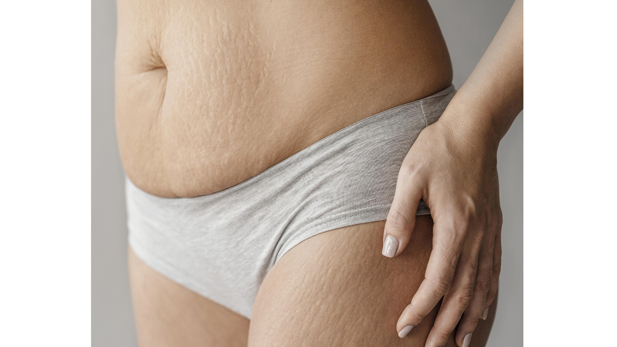 Estrías en la zona del abdomen y los muslos (Freepik)