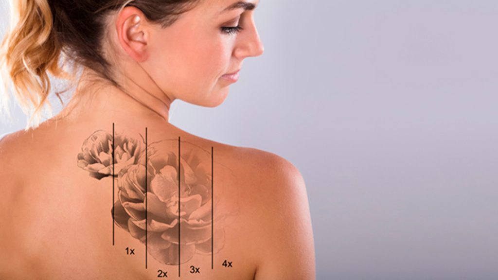 Proceso de eliminación de tatuaje (Clínicas Dorsia)