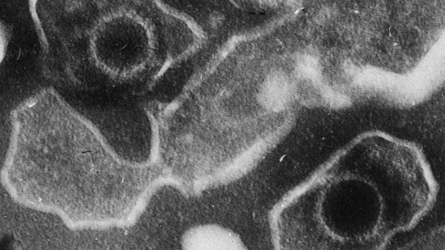 El virus de Epstein-Barr, causante de la mononucleosis, podría ser la causa principal de la esclerosis múltiple