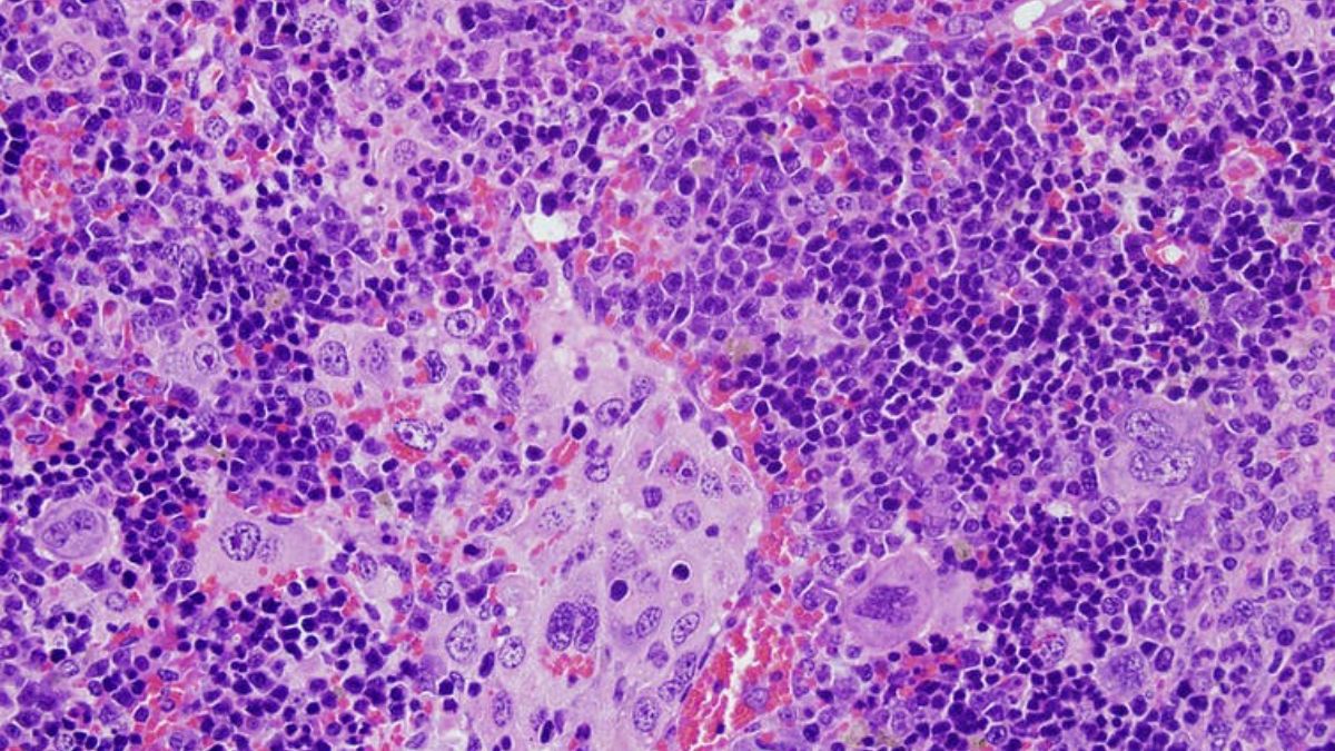 ¿Qué mutaciones genéticas son realmente importantes para el desarrollo del cáncer?