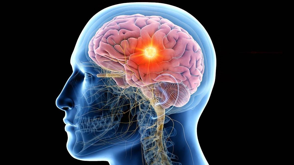 Una terapia experimental logra eliminar un tumor cerebral incurable en animales