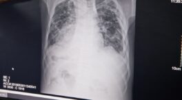 La notificación de casos de tuberculosis en España cae un 23% por la pandemia