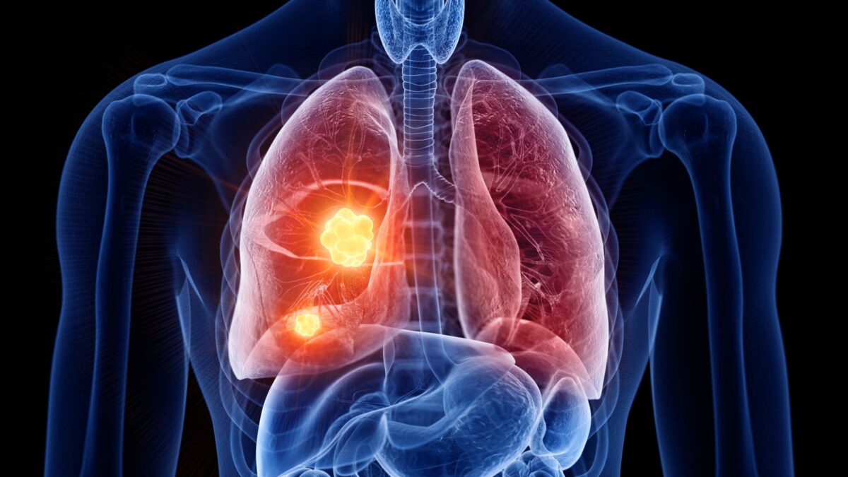 Combinar quimio e inmunoterapia antes de operar mejora el pronóstico de los enfermos de cáncer de pulmón