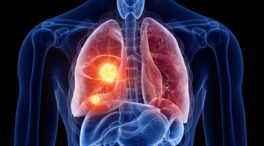 Combinar quimio e inmunoterapia antes de operar mejora el pronóstico de los enfermos de cáncer de pulmón