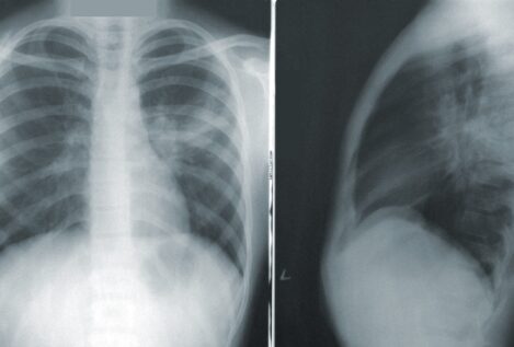 Hito médico: un equipo español logra acabar con el cáncer de pulmón en un 37% de casos