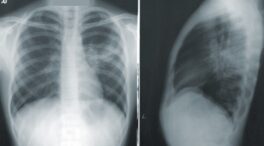 Hito médico: un equipo español logra acabar con el cáncer de pulmón en un 37% de casos