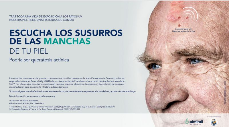 El 28,6% de la población española de más de 45 años padece queratosis actínica
