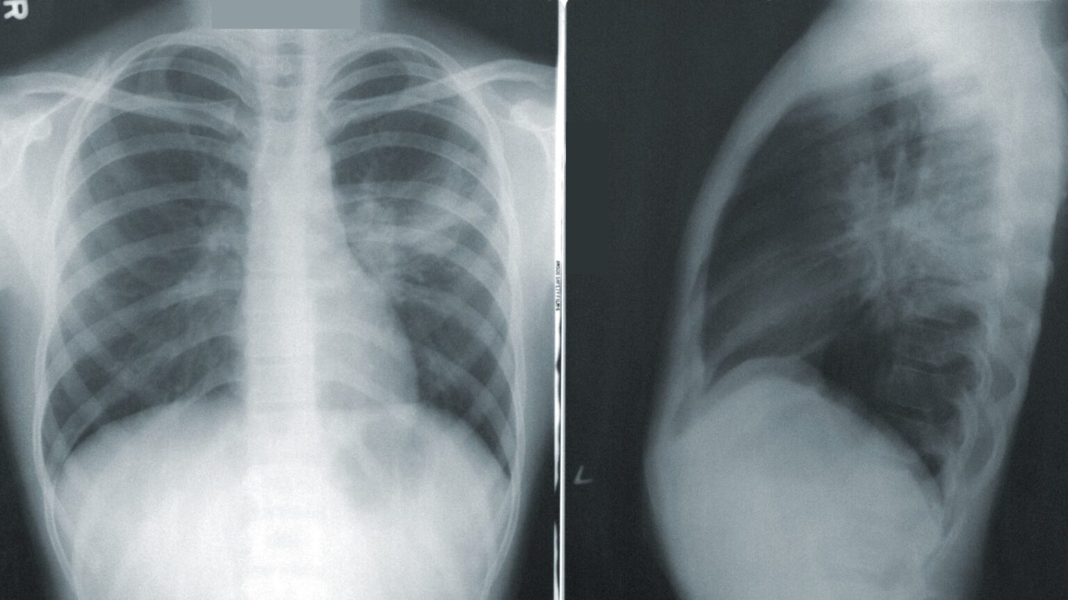 Hito médico: un equipo español logra acabar con el cáncer de pulmón en un 37% de casos