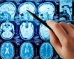 La inteligencia artificial revela variaciones en la anatomía cerebral de personas con autismo