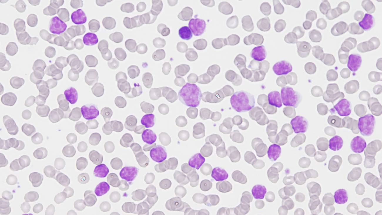 Gran avance científico: completado el mapa genómico de la leucemia linfática crónica