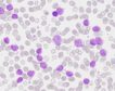 Gran avance científico: completado el mapa genómico de la leucemia linfática crónica