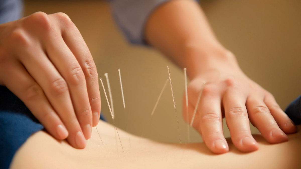 Un nuevo estudio sugiere que la acupuntura podría ayudar a prevenir la diabetes