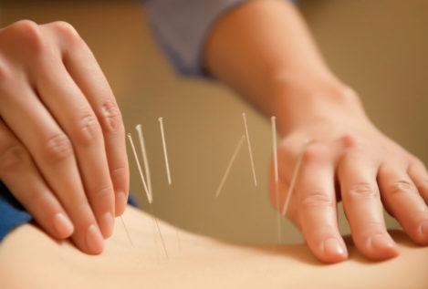 Un nuevo estudio sugiere que la acupuntura podría ayudar a prevenir la diabetes