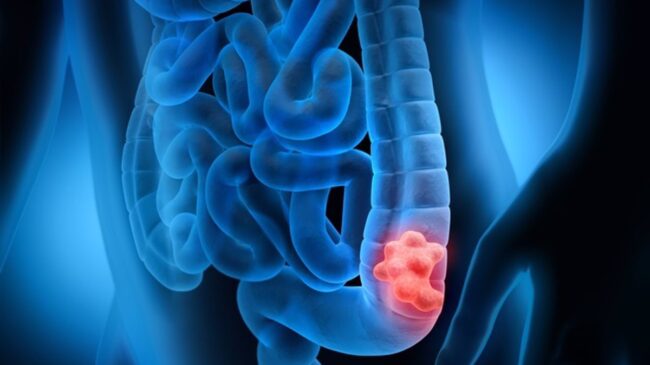 Logran prevenir el dolor neuropático asociado a la quimioterapia del cáncer de colon