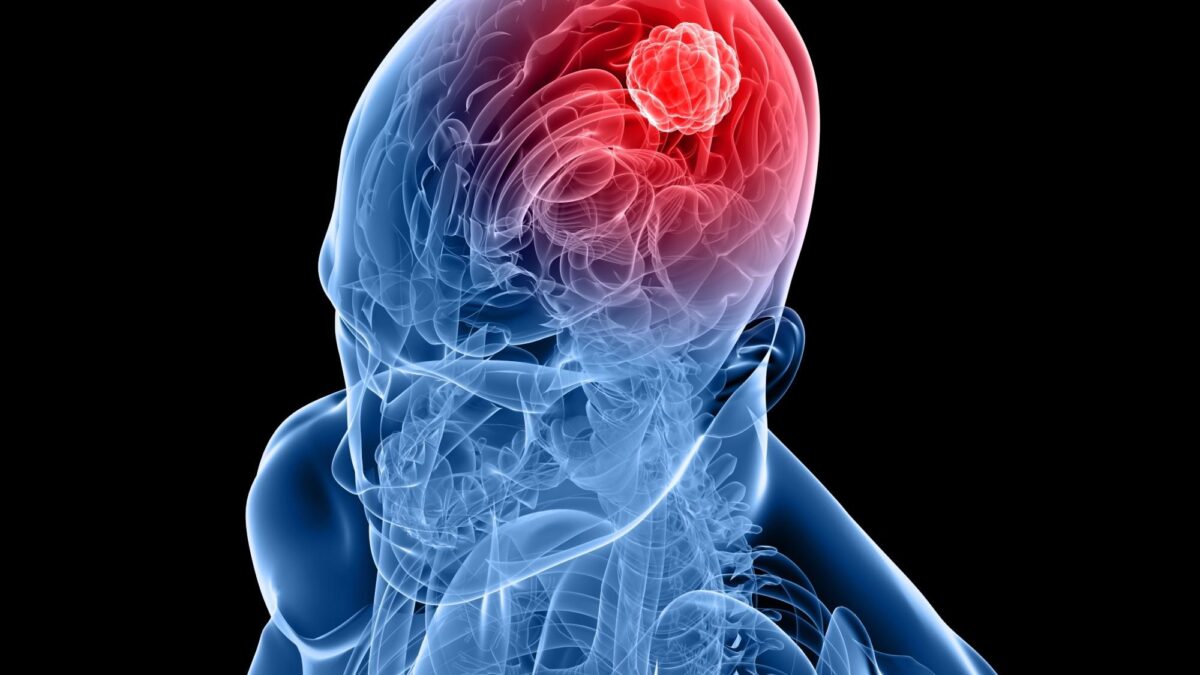 Un nuevo fármaco muestra eficacia contra el tumor cerebral más común y agresivo