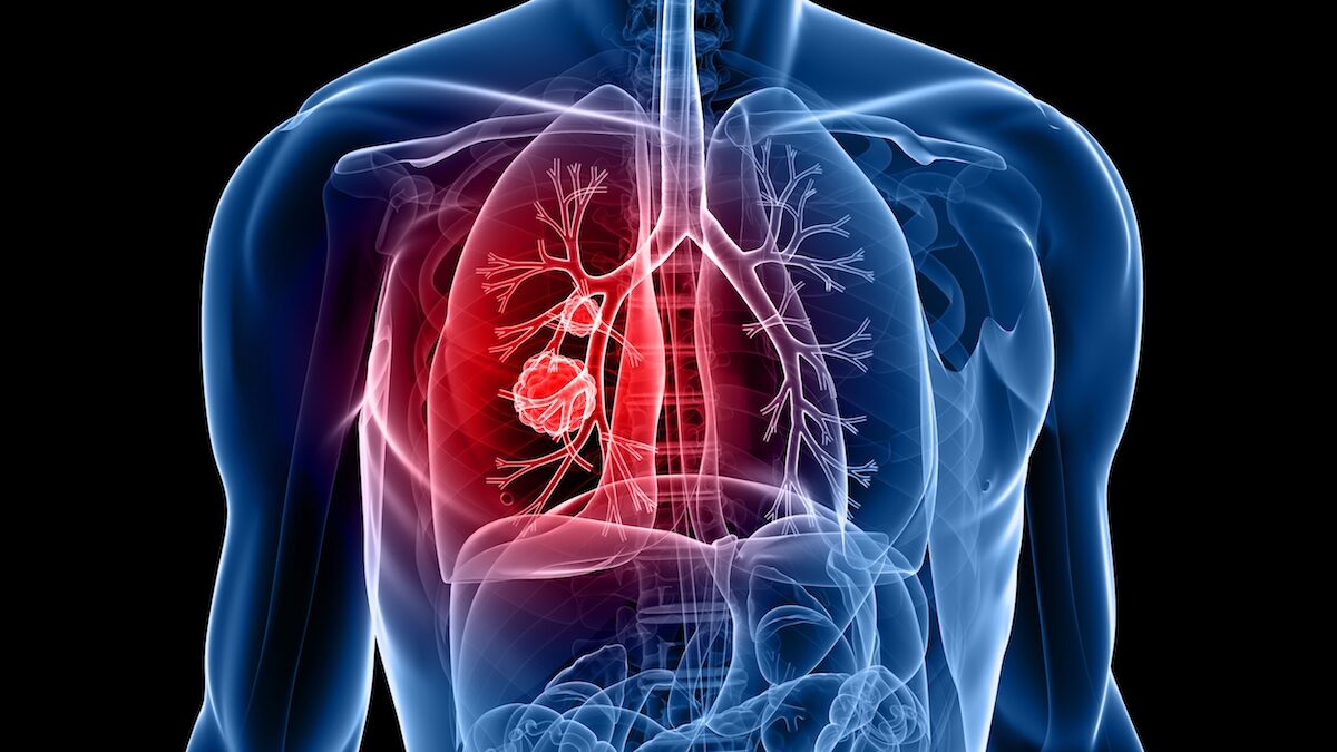 Una terapia combinada sube un 20% la supervivencia en cáncer de pulmón intermedio