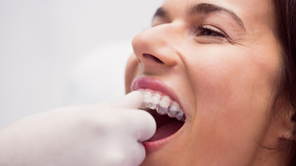 Un dentista coloca férulas de descarga a una mujer para preservar su salud dental