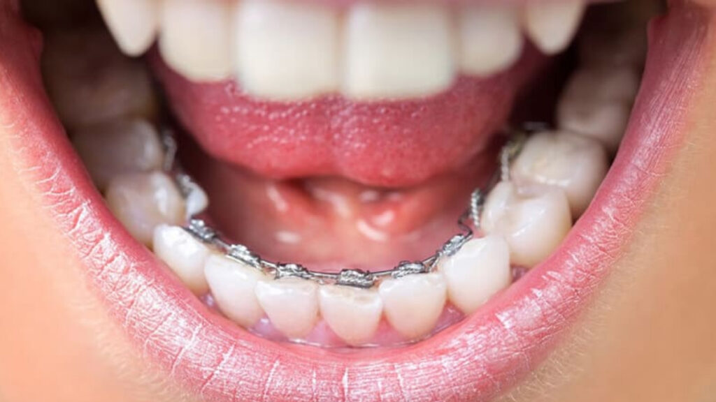 Una ortodoncia lingual realizada en la clínica Ferrús y Bratos.