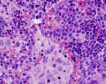 El CSIC revela una mutación genética clave en la aparición de linfomas y el cáncer de pulmón