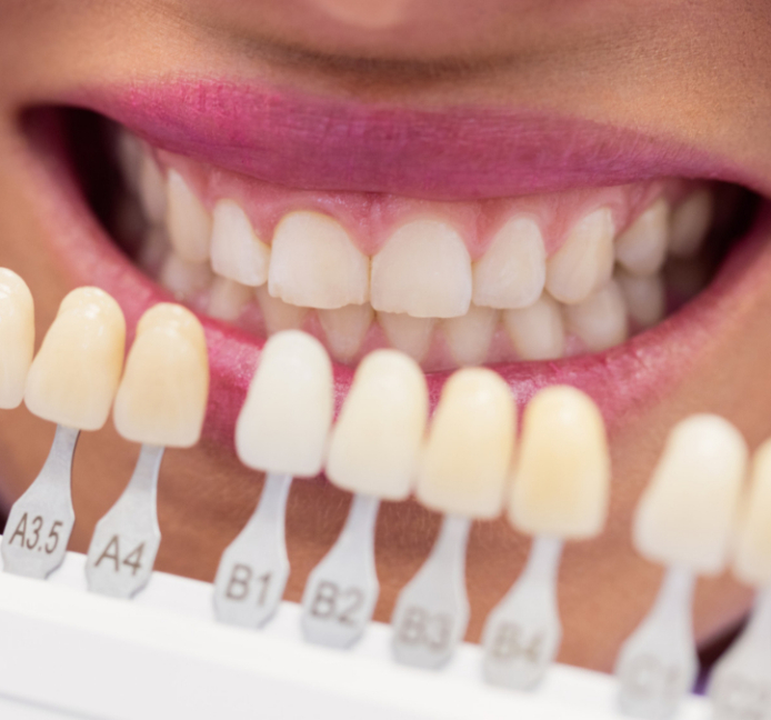 Los cuatro peores errores más comunes después de un blanqueamiento dental