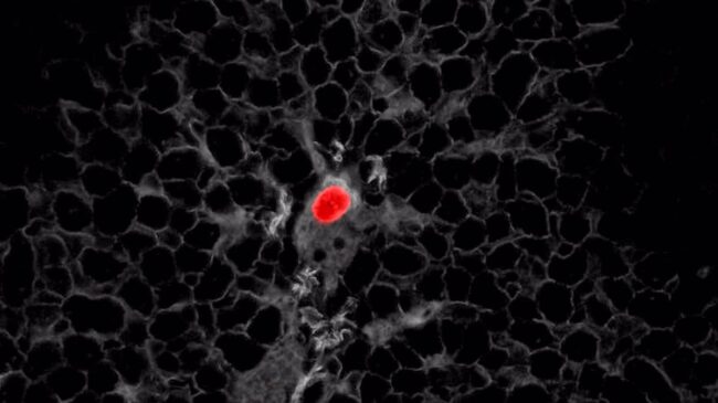 Científicos españoles identifican las células que causan las recaídas de cáncer de colon