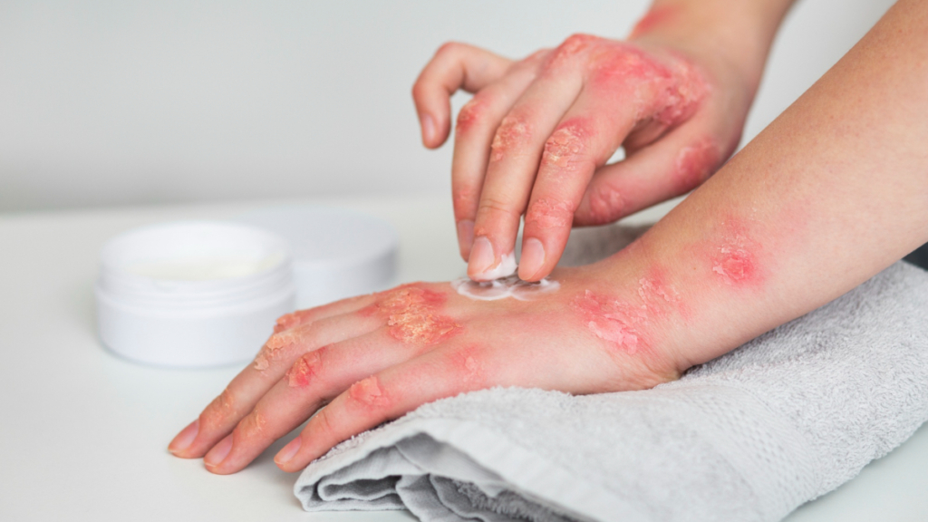 Una mujer con psoriasis en las manos se aplica crema