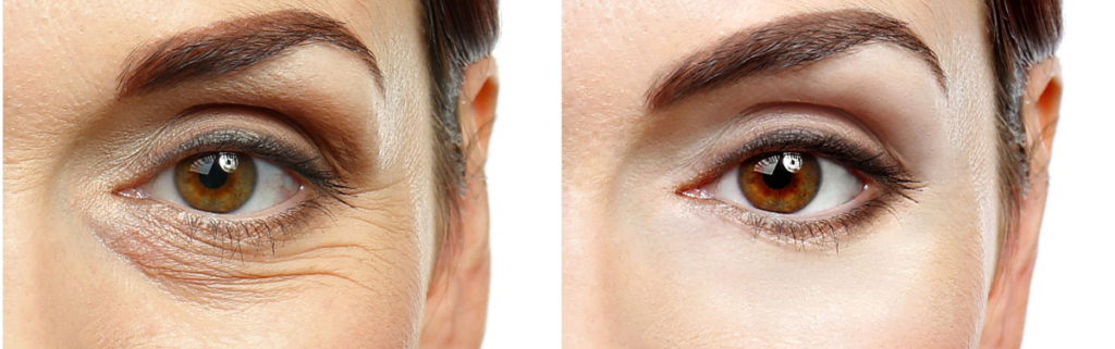 Antes y después del contorno de ojos usando cosmética con oro. (Fuente: Q77+)